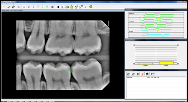 Cavity Scan - Before