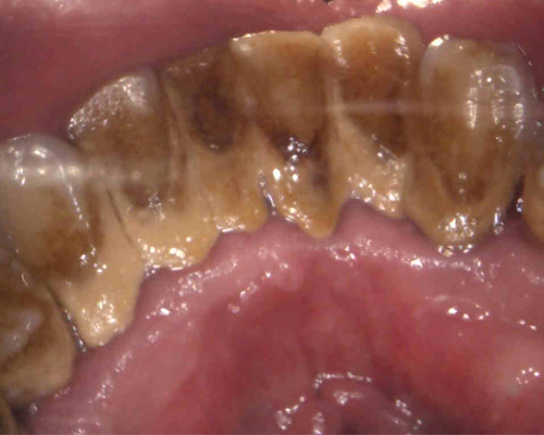 Severe Gum Disease